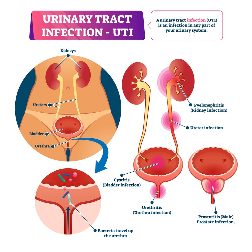 what is a UTI